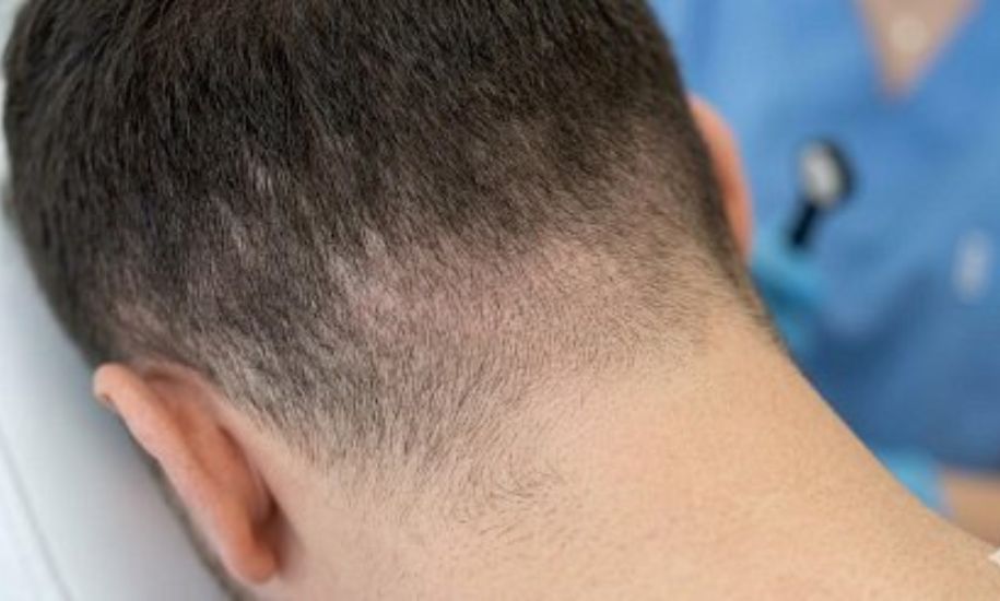 Hair Transplant
