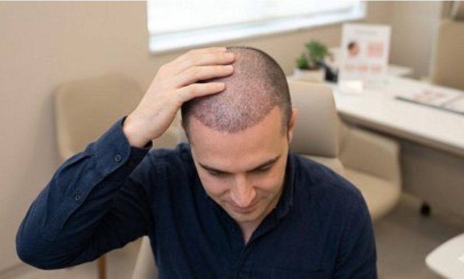 Hair Transplant