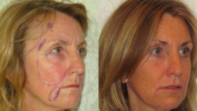 Deep Plane Facelift Scars