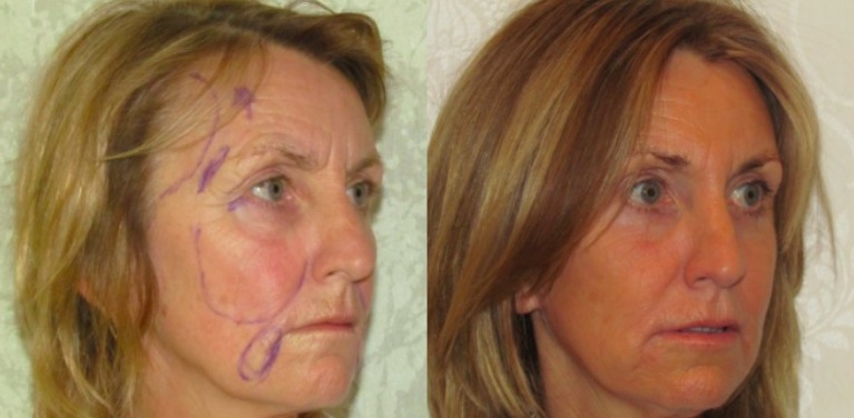 Deep Plane Facelift Scars